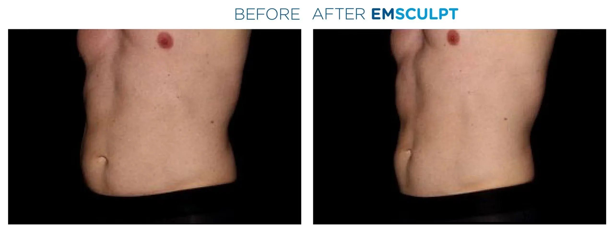 Emsculpt Neo - Before and After