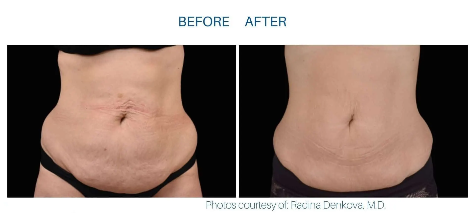 Emsculpt Neo  before and after